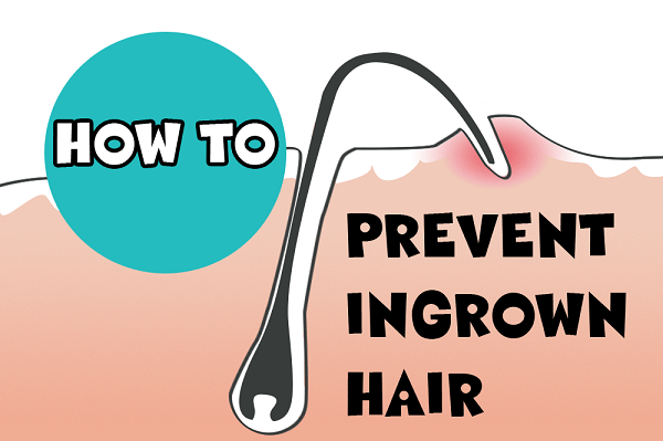 6 ways to get rid of ingrown hair 9
