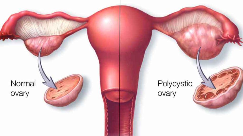 Polycystic-Ovaries-Vs-Normal-Ovaries