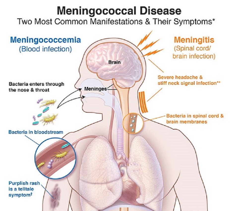 Meningococcal Meningitis - Symptoms & Types
